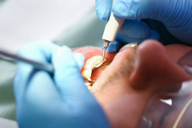 Best Emergency Wisdom Teeth Removal in Candor, NC